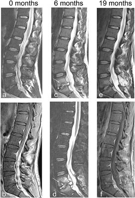 Primary Spinal Epidural Abscesses Not Associated With Pyogenic Infectious Spondylodiscitis: A New Pathogenetic Hypothesis